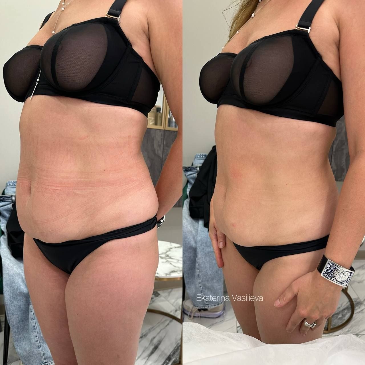 2-Week Weight Loss Transformation with #Retatrutide! 🔥